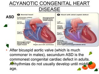ACYANOTIC CONGENITAL HEART
DISEASE
ASD
• After bicuspid aortic valve (which is much
commoner in males), secundum ASD is the
commonest congenital cardiac defect in adults.
Arrhythmias do not usually develop until middle
age.
 
