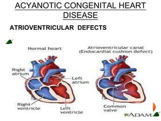 ACYANOTIC CONGENITAL HEART
DISEASE
ATRIOVENTRICULAR DEFECTS
 