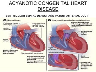 ACYANOTIC CONGENITAL HEART
DISEASE
VENTRICULAR SEPTAL DEFECT AND PATENT ARTERIAL DUCT
 