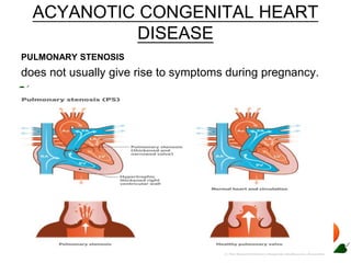 ACYANOTIC CONGENITAL HEART
DISEASE
PULMONARY STENOSIS
does not usually give rise to symptoms during pregnancy.
 