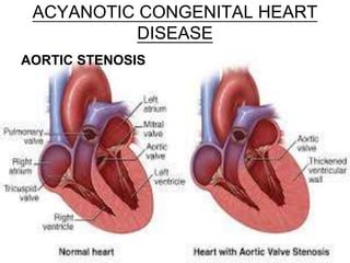 ACYANOTIC CONGENITAL HEART
DISEASE
AORTIC STENOSIS
 