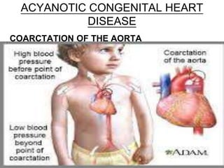 ACYANOTIC CONGENITAL HEART
DISEASE
COARCTATION OF THE AORTA
 
