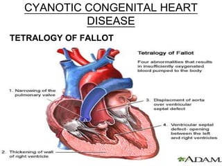 CYANOTIC CONGENITAL HEART
DISEASE
TETRALOGY OF FALLOT
 