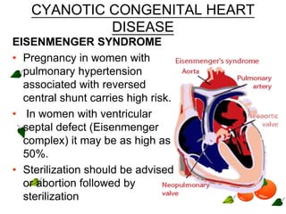 CYANOTIC CONGENITAL HEART
DISEASE
EISENMENGER SYNDROME
• Pregnancy in women with
pulmonary hypertension
associated with reversed
central shunt carries high risk.
• In women with ventricular
septal defect (Eisenmenger
complex) it may be as high as
50%.
• Sterilization should be advised
or abortion followed by
sterilization
 