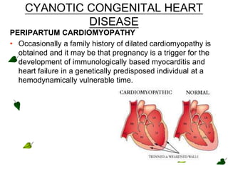 CYANOTIC CONGENITAL HEART
DISEASE
PERIPARTUM CARDIOMYOPATHY
• Occasionally a family history of dilated cardiomyopathy is
obtained and it may be that pregnancy is a trigger for the
development of immunologically based myocarditis and
heart failure in a genetically predisposed individual at a
hemodynamically vulnerable time.
 