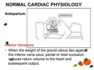 NORMAL CARDIAC PHYSIOLOGY
Antepartum
Inferior Venacava
• When the weight of the gravid uterus lies against
the inferior vena cava, partial or total occlusion
reduces return volume to the heart and
subsequent output.
 