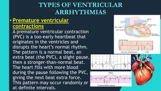 Pvc Med Term Cardiac dysrhythmias | PPTX