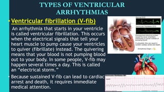 Vi Fib Cardiac dysrhythmias | PPTX