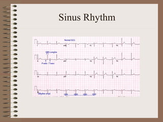 Sinus R1 Cardiac Ecg Interpretation | PDF