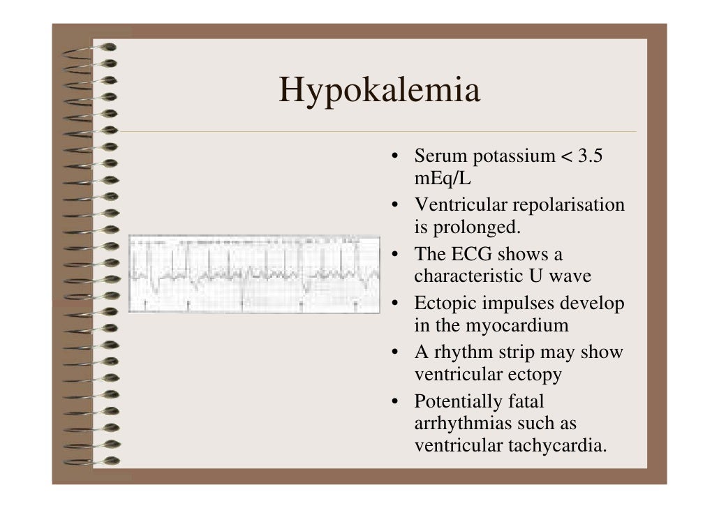 Hypokalemia On Ekg Shows: Ecg Hypokaliémie Mnémotechnique – AYJQE