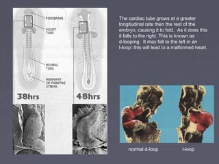 The cardiac tube grows at a greater
longitudinal rate then the rest of the
embryo, causing it to fold. As it does this
it falls to the right. This is known as
d-looping. It may fall to the left in an
l-loop: this will lead to a malformed heart.




    normal d-loop              l-loop
 