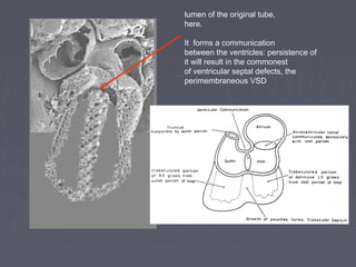 lumen of the original tube,
here.

It forms a communication
between the ventricles: persistence of
it will result in the commonest
of ventricular septal defects, the
perimembraneous VSD
 