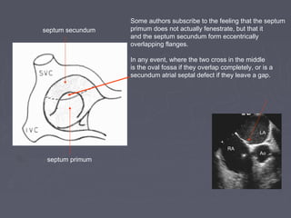 Some authors subscribe to the feeling that the septum
septum secundum   primum does not actually fenestrate, but that it
                  and the septum secundum form eccentrically
                  overlapping flanges.

                  In any event, where the two cross in the middle
                  is the oval fossa if they overlap completely, or is a
                  secundum atrial septal defect if they leave a gap.




                                                                  LA


                                                      RA
                                                                  Ao
 septum primum
 