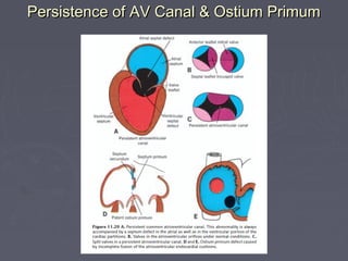Persistence of AV Canal & Ostium Primum
 