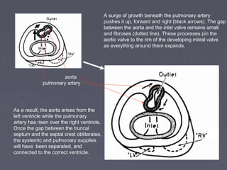 A surge of growth beneath the pulmonary artery
                                             pushes it up, forward and right (black arrows). The gap
                                             between the aorta and the inlet valve remains small
                                             and fibroses (dotted line). These processes pin the
                                             aortic valve to the rim of the developing mitral valve
                                             as everything around them expands.




                      aorta
             pulmonary artery




As a result, the aorta arises from the
left ventricle while the pulmonary
artery has risen over the right ventricle.
Once the gap between the truncal
septum and the septal crest obliterates,
the systemic and pulmonary supplies
will have been separated, and
connected to the correct ventricle.
 