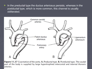 ►   In the preductal type the ductus arteriosus persists, whereas in the
    postductal type, which is more common, this channel is usually
    obliterated.
 