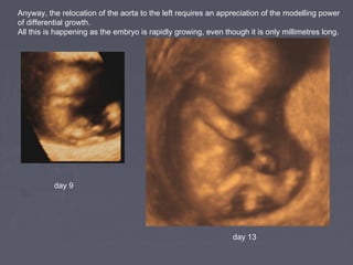 Anyway, the relocation of the aorta to the left requires an appreciation of the modelling power
of differential growth.
All this is happening as the embryo is rapidly growing, even though it is only millimetres long.




          day 9




                                                                day 13
 