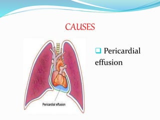 CAUSES
 Pericardial
effusion
 