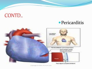 CONTD..
Pericarditis
 