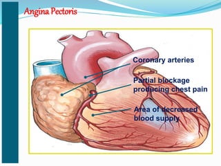 Angina Pectoris
Coronary arteries
Partial blockage
producing chest pain
Area of decreased
blood supply
 