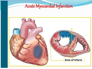 Acute Myocardial Infarction
Area of Infarct
 