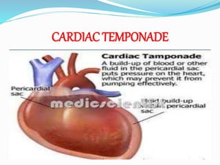 CARDIAC TEMPONADE
 