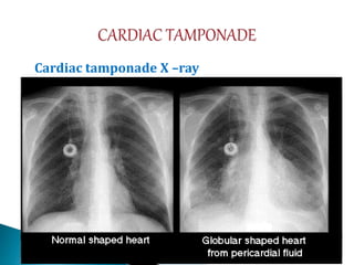 Cardiac tamponade X –ray
 