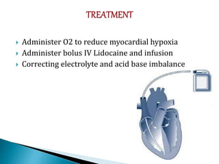  Administer O2 to reduce myocardial hypoxia
 Administer bolus IV Lidocaine and infusion
 Correcting electrolyte and acid base imbalance
 
