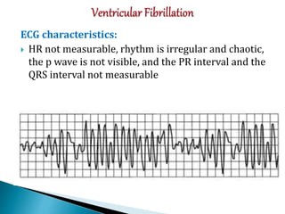 ECG characteristics:
 HR not measurable, rhythm is irregular and chaotic,
the p wave is not visible, and the PR interval and the
QRS interval not measurable
 