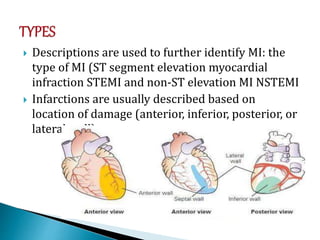  Descriptions are used to further identify MI: the
type of MI (ST segment elevation myocardial
infraction STEMI and non-ST elevation MI NSTEMI
 Infarctions are usually described based on
location of damage (anterior, inferior, posterior, or
lateral wall)
 