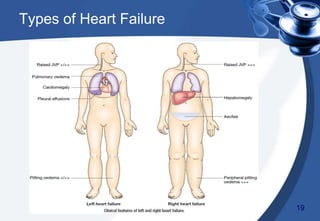 Types of Heart Failure
19
 