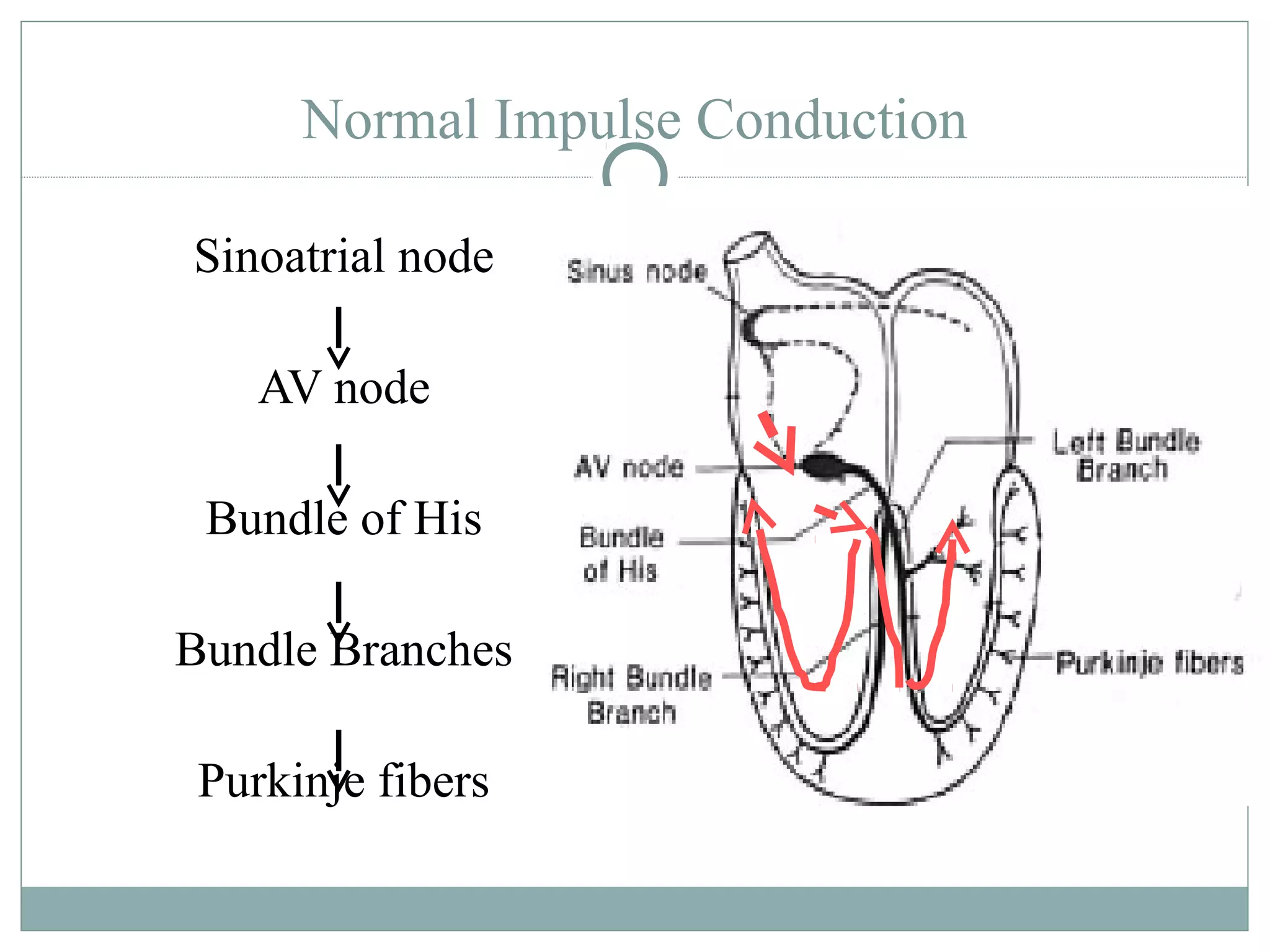 Normal Impulse Conduction
Sinoatrial node
AV node
Bundle of His
Bundle Branches
Purkinje fibers
 
