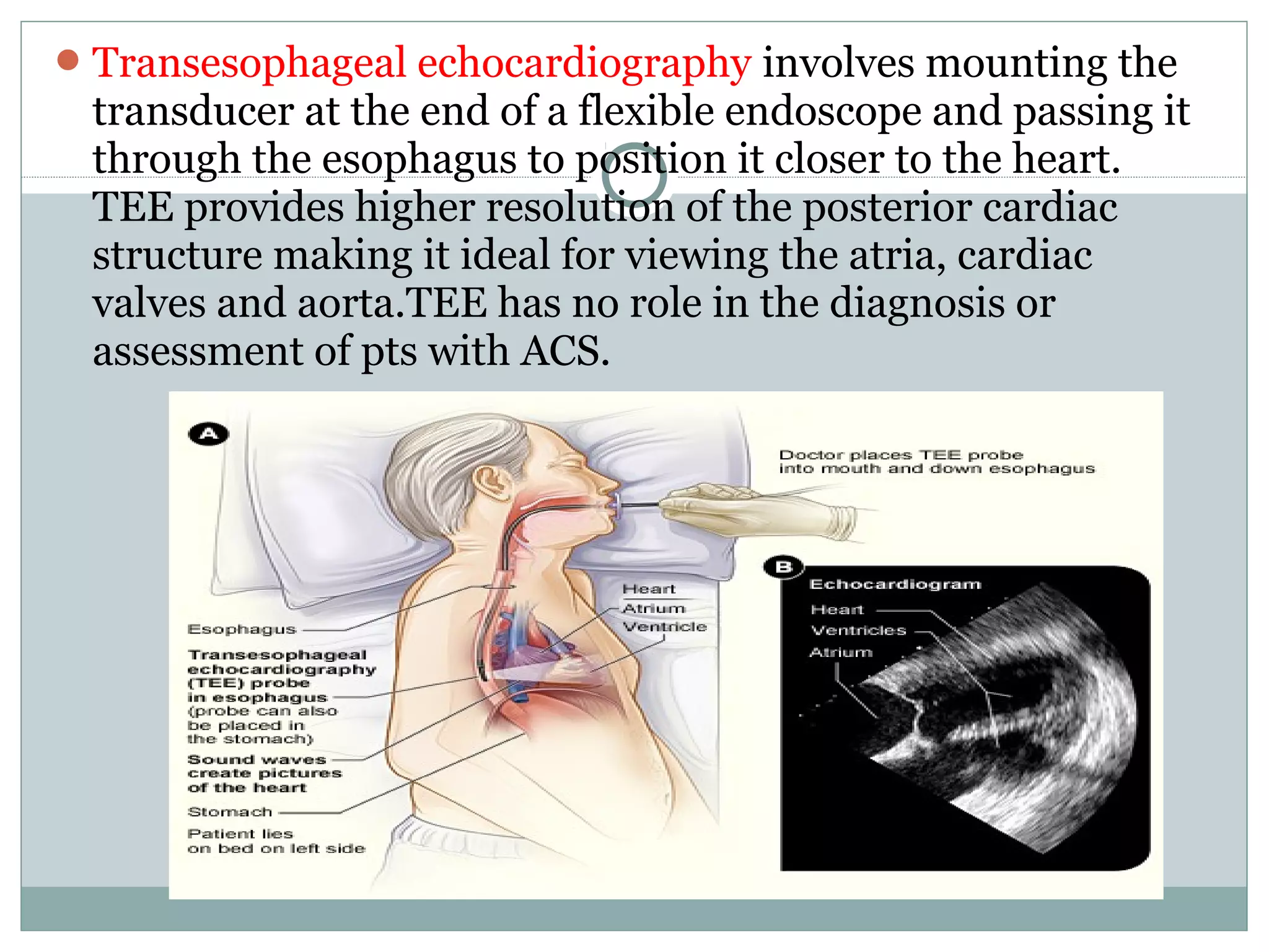 Transesophageal echocardiography involves mounting the
transducer at the end of a flexible endoscope and passing it
through the esophagus to position it closer to the heart.
TEE provides higher resolution of the posterior cardiac
structure making it ideal for viewing the atria, cardiac
valves and aorta.TEE has no role in the diagnosis or
assessment of pts with ACS.
 