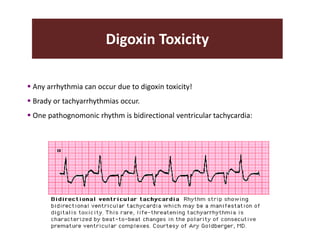 Digoxin Toxicity
 Any arrhythmia can occur due to digoxin toxicity!
 Brady or tachyarrhythmias occur.
 One pathognomonic rhythm is bidirectional ventricular tachycardia:
 