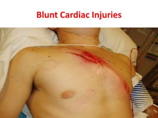 Blunt Cardiac Injuries
 