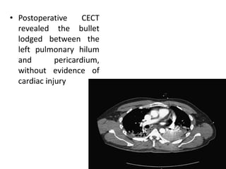 • Postoperative CECT
revealed the bullet
lodged between the
left pulmonary hilum
and pericardium,
without evidence of
cardiac injury
 