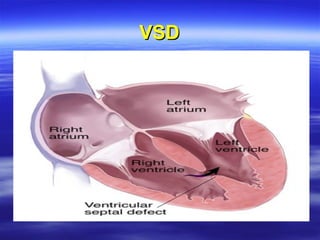 Vsd Incedence Cardiac lecture pediatrics fall 2012 | PPT