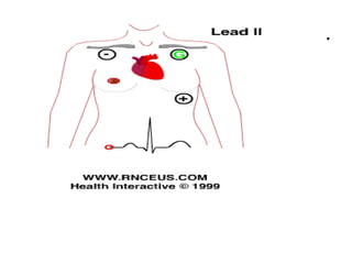 Electrocardiogram Tip Confirmation System.pdf Cardiac monitoring.pdf