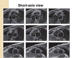 Short-axis view
 