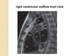 right ventricular outflow tract view
 