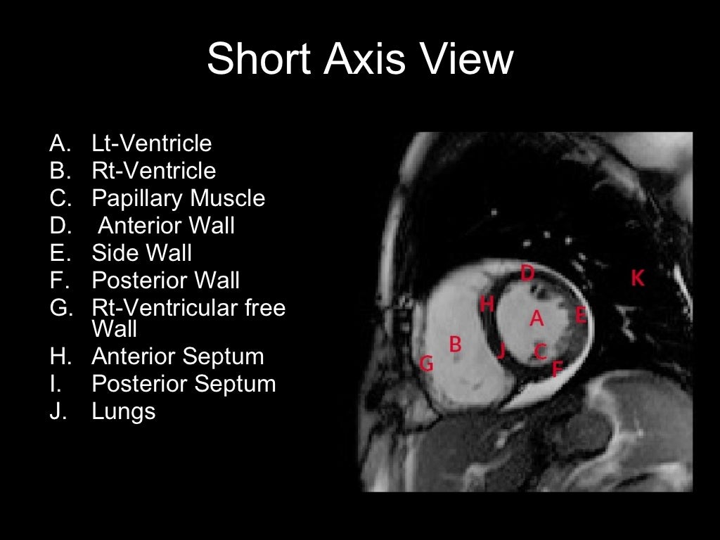 Cardiac mri&slice anatomy