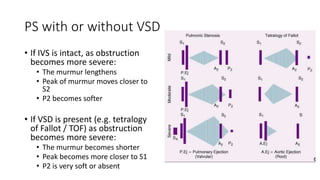 PS with or without VSD
• If IVS is intact, as obstruction
becomes more severe:
• The murmur lengthens
• Peak of murmur moves closer to
S2
• P2 becomes softer
• If VSD is present (e.g. tetralogy
of Fallot / TOF) as obstruction
becomes more severe:
• The murmur becomes shorter
• Peak becomes more closer to S1
• P2 is very soft or absent
 