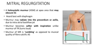 MITRAL REGURGITATION
• A holosystolic murmur (HSM) at apex area that may
obscure S1
• Heard best with diaphragm
• Murmur may radiate into the precordium or axilla,
due to intra-atrial backflow jet
• Murmur becomes softer with inspiration unlike
murmur of TR (turns loud)
• Murmur of MR is ‘rumbling’ as opposed to musical
quality of fibro-calcific AS
 