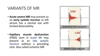 VARIANTS OF MR
• Acute severe MR may present as
an early systolic murmur as left
atrium has a normal size with
limited distensibility.
• Papillary muscle dysfunction
(PMD) seen in acute MI may
present as an late systolic
murmur without a preceding
click. Also called ischemic MR
 