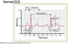 Normal ECG
PQRST waves represent one complete cardiac cycle
 