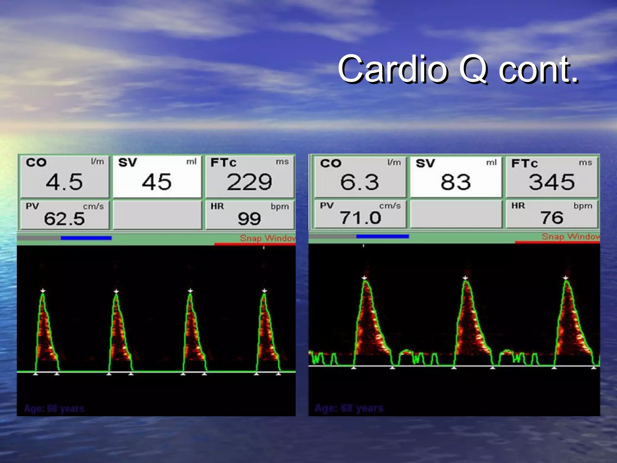Cardio Q cont.
 