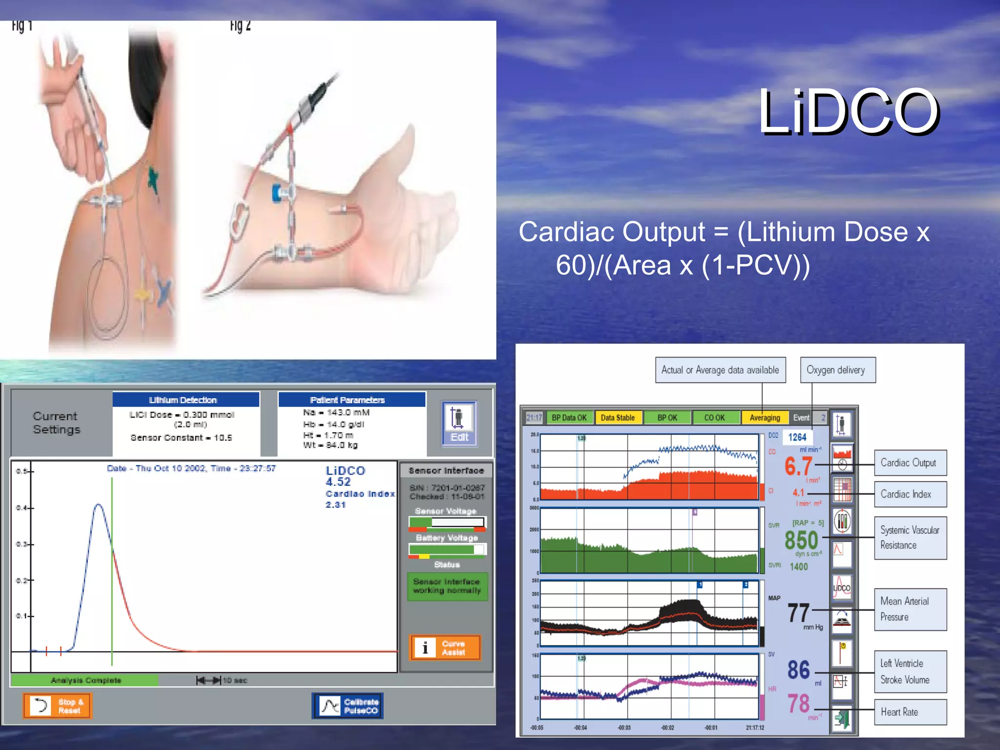 LiDCO
Cardiac Output = (Lithium Dose x
  60)/(Area x (1-PCV))
 