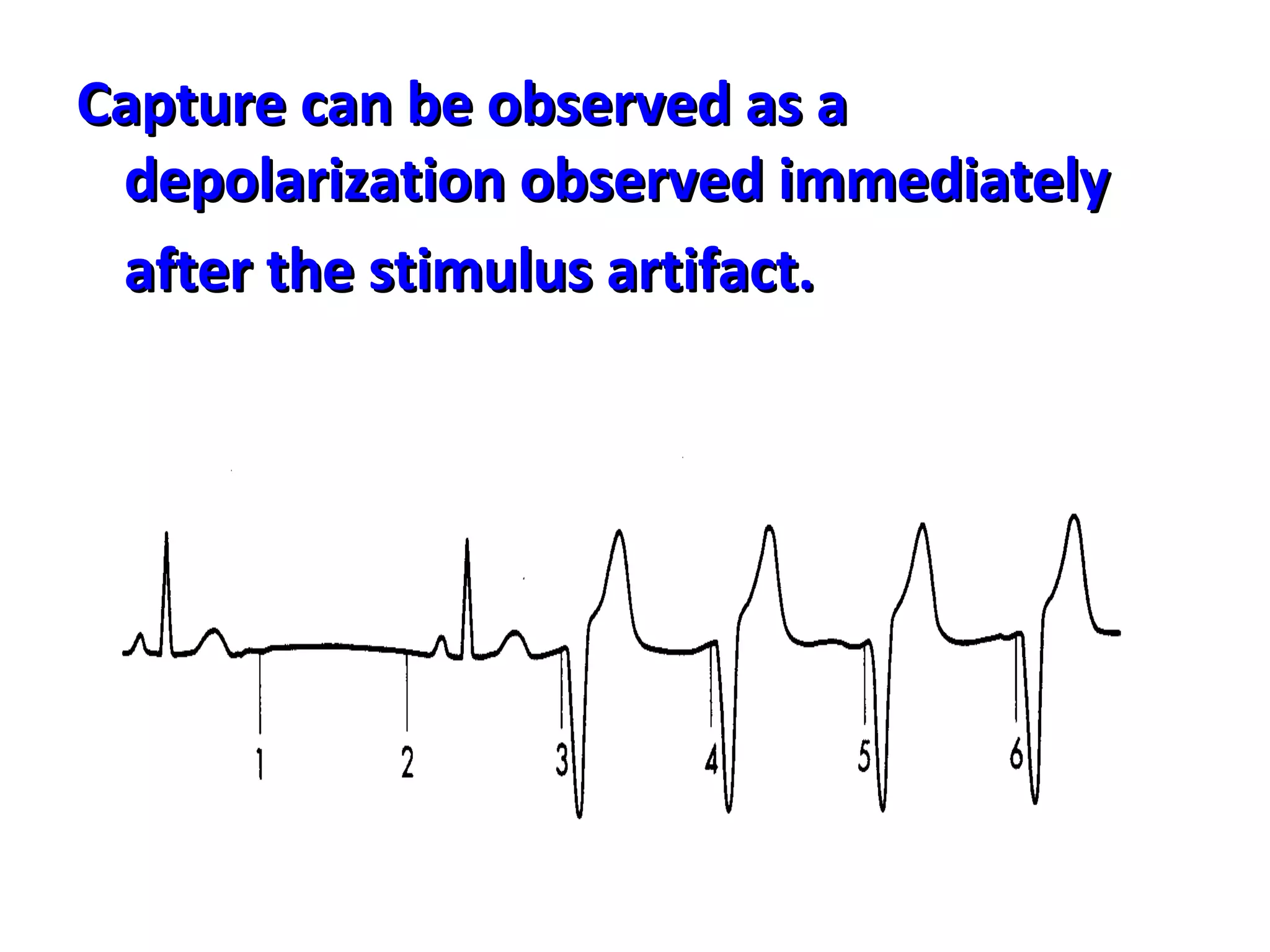 Capture can be observed as a Capture can be observed as a 
depolarization observed immediately depolarization observed immediately 
after the stimulus artifact.after the stimulus artifact.  
 