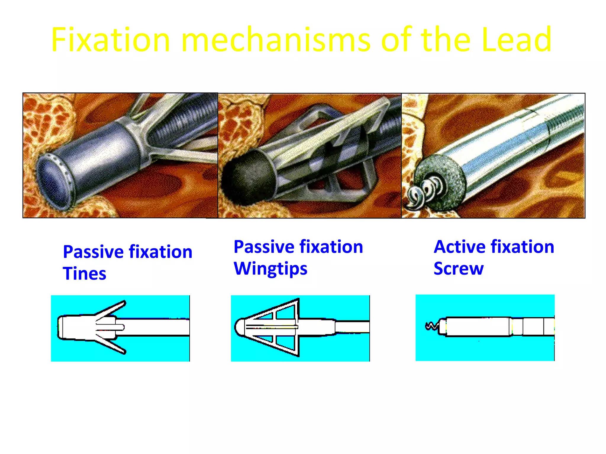 Fixation mechanisms of the Lead
Passive fixation
Wingtips
Active fixation
Screw
Passive fixation
Tines
 