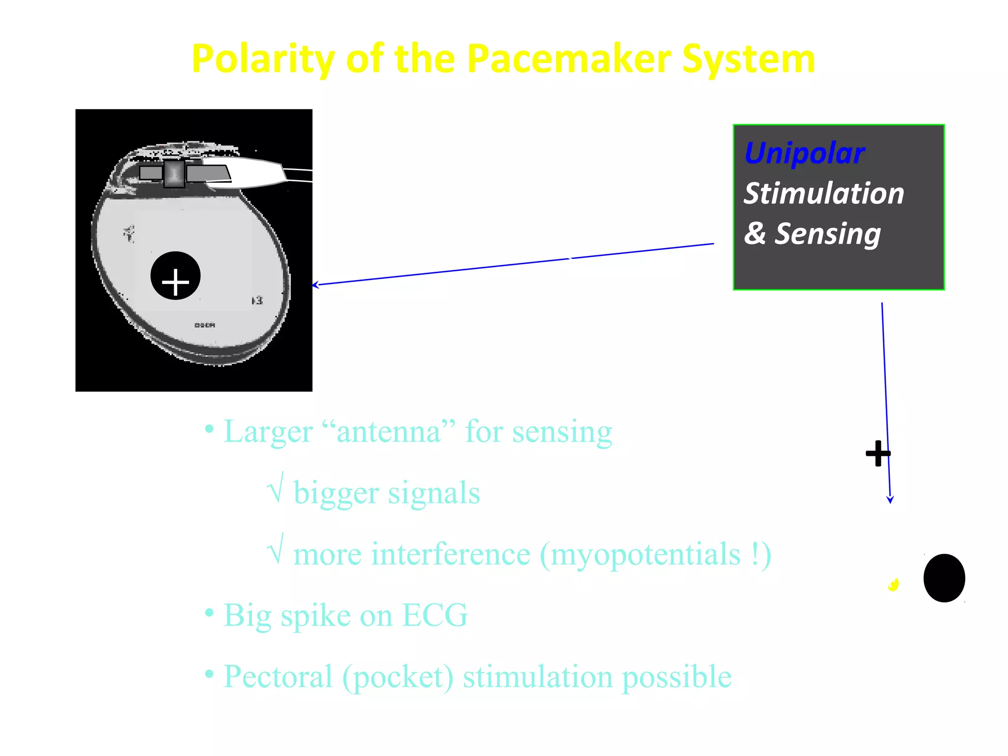 -
Unipolar
Stimulation
& Sensing
Polarity of the Pacemaker System
• Larger “antenna” for sensing
√ bigger signals
√ more interference (myopotentials !)
• Big spike on ECG
• Pectoral (pocket) stimulation possible
+
+
 